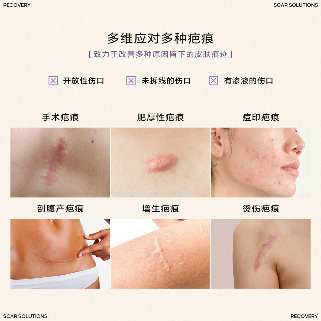 Silicone Scar Stick SILICONE SCAR STICK Acne Marks and Pits Care Lightening Cream Silicone Scar Gel