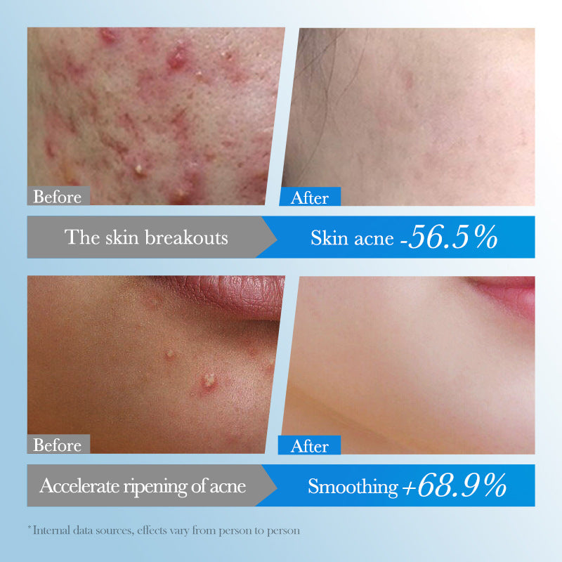 Acne patch SADOER Acne Removal and Repair Patch Colorful Student Acne Treatment Cross-Border Foreign Trade Factory Direct Sales