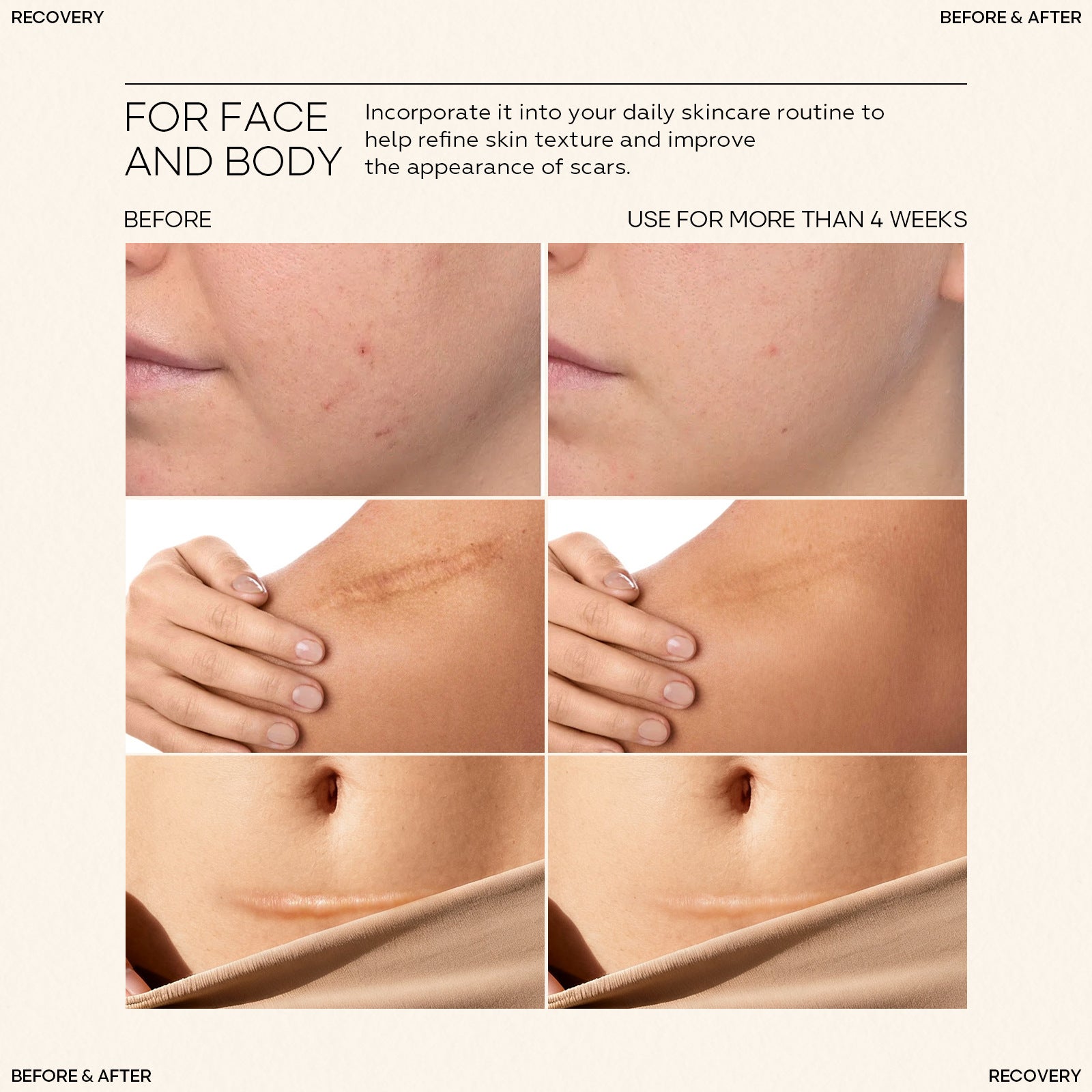 Silicone Scar Stick SILICONE SCAR STICK Acne Marks and Pits Care Lightening Cream Silicone Scar Gel