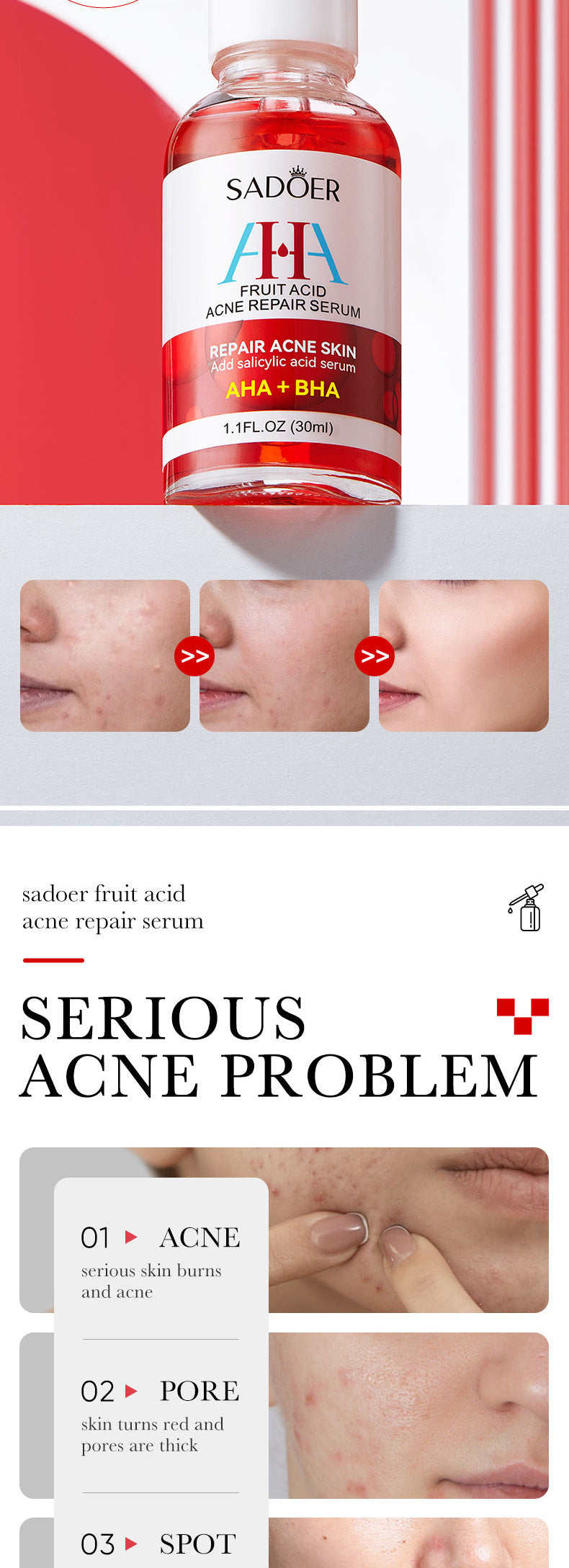 Anti-acne Serum SADOER Fruit Acid Fades Acne Marks, Hydrates and Moisturizes, Cross-Border Wholesale