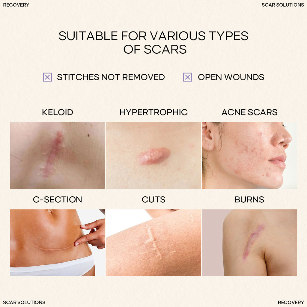 Silicone Scar Stick SILICONE SCAR STICK Acne Marks and Pits Care Lightening Cream Silicone Scar Gel