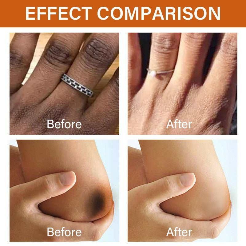 Joint Darkening Essence for Knees and Ankles, Brightens Skin Tone and Reduces Spots Full Coverage Dark Spot Removal Essence