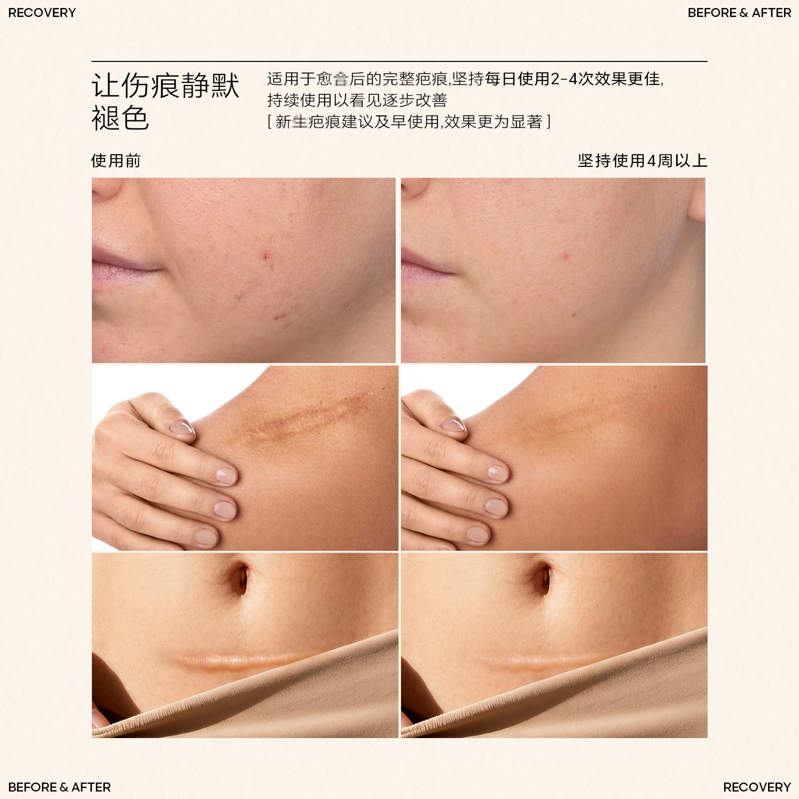 Silicone Scar Stick SILICONE SCAR STICK Acne Marks and Pits Care Lightening Cream Silicone Scar Gel