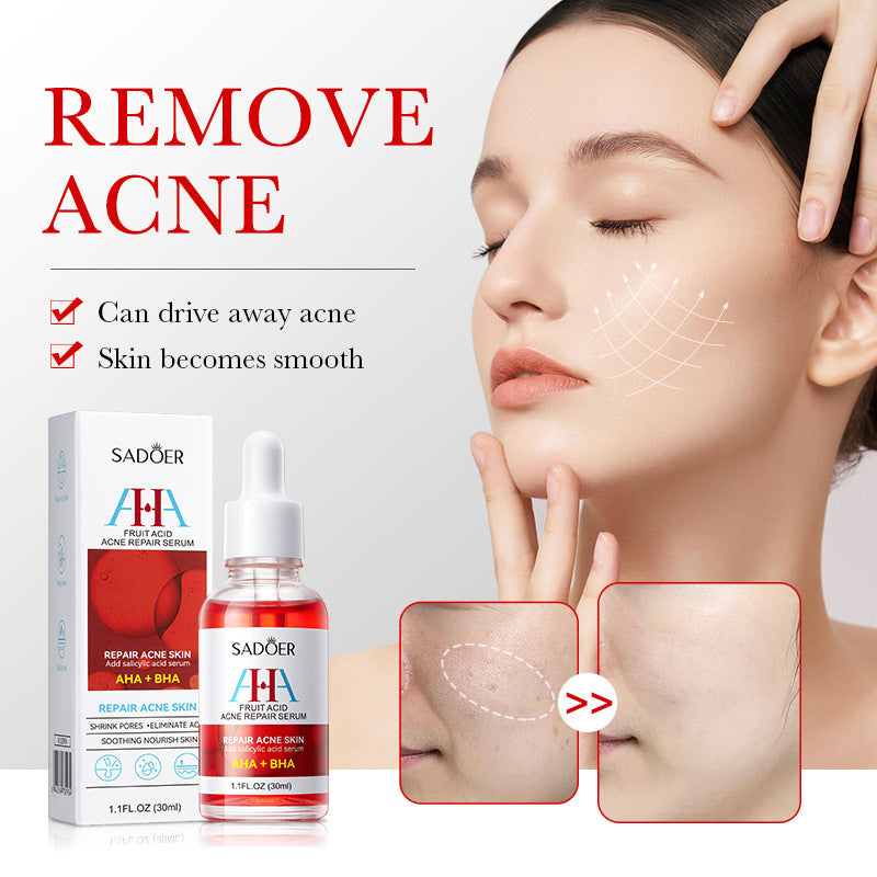 Anti-acne Serum SADOER Fruit Acid Fades Acne Marks, Hydrates and Moisturizes, Cross-Border Wholesale